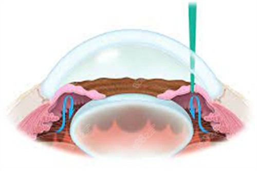 虹膜切除術 青光眼 虹膜切除術 青光眼