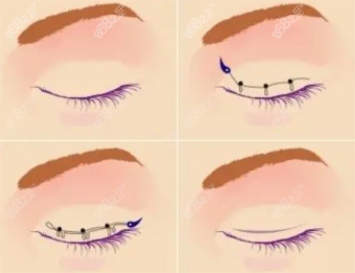 雙眼皮手術(shù)示意圖 雙眼皮手術(shù)示意圖