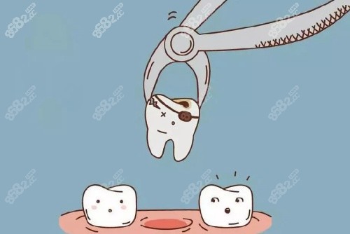 牙齒種植拔牙卡通示意圖 牙齒種植拔牙卡通示意圖