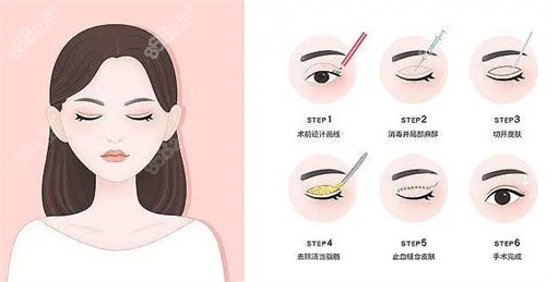 全切雙眼皮過程卡通圖 全切雙眼皮過程卡通圖