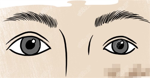 雙眼皮大小眼修復(fù) 雙眼皮大小眼修復(fù)