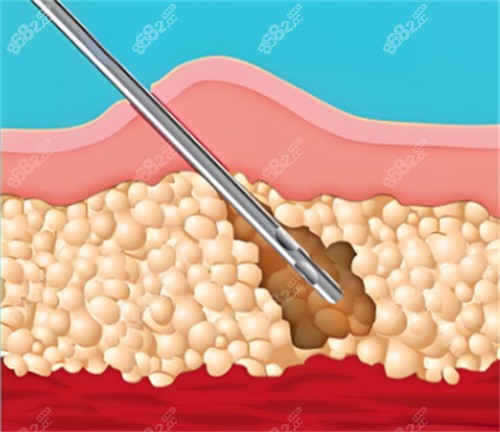 吸脂手術(shù)皮膚層 吸脂手術(shù)皮膚層