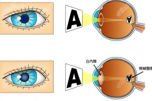 白內(nèi)障和正常眼睛卡通對(duì)比圖 白內(nèi)障和正常眼睛卡通對(duì)比圖