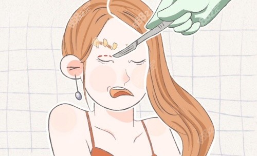 拉雙眼皮示意圖 拉雙眼皮示意圖