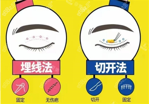 雙眼皮埋線和切開對比圖 雙眼皮埋線和切開對比圖