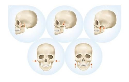 磨骨手術手術過程 磨骨手術手術過程