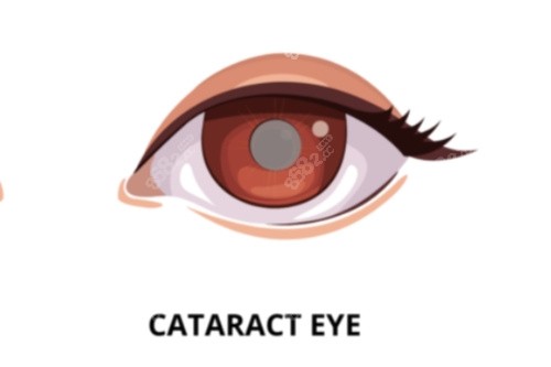 白內(nèi)障眼睛 白內(nèi)障眼睛