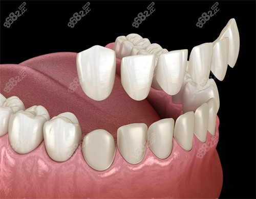 牙齒貼面改善牙齒顏色和形狀 牙齒貼面改善牙齒顏色和形狀