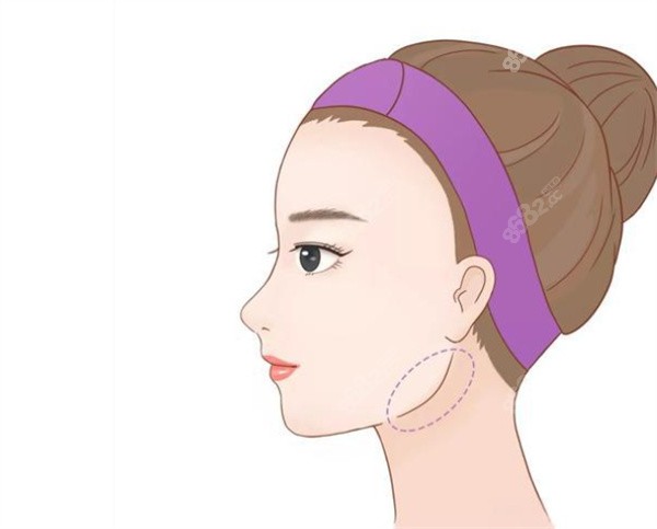 南京吳國平做下頜角手術(shù)好嗎？2026吳國平院長長曲線截骨風格及術(shù)后平整度