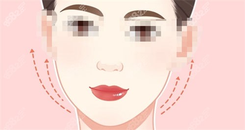 拉皮手術(shù)后面部提拉示意圖