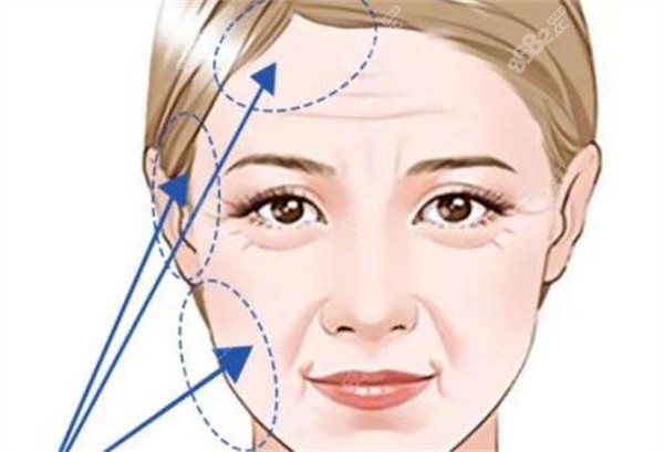 拉皮整形手術(shù)