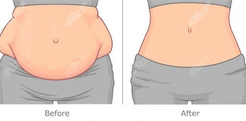 腹壁整形改善對(duì)比卡通圖 腹壁整形改善對(duì)比卡通圖