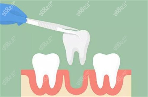 牙齒拔除改善圖 牙齒拔除改善圖
