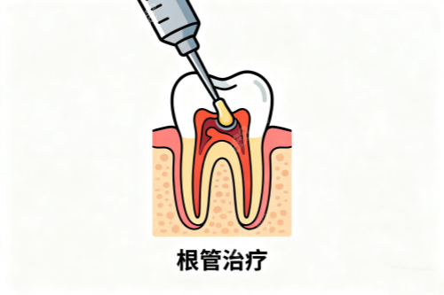 根管治療卡通圖一覽
