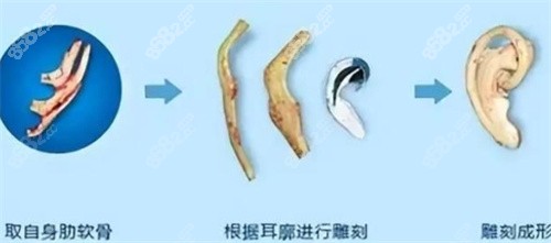 耳再造肋軟骨雕刻成型的過程 耳再造肋軟骨雕刻成型的過程