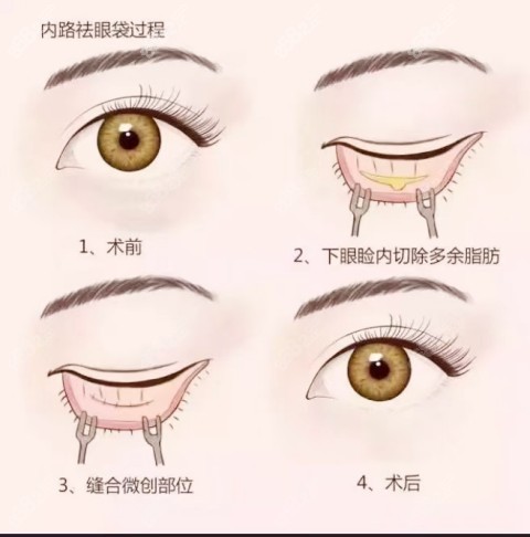 內(nèi)路祛眼袋圖示 內(nèi)路祛眼袋圖示