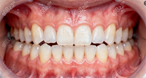 牙齒整齊圖片 牙齒整齊圖片