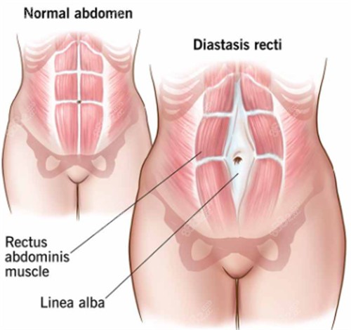 腹壁成形手術(shù)前后對比圖一覽