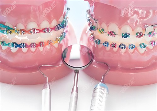 牙齒矯正模型圖片 牙齒矯正模型圖片