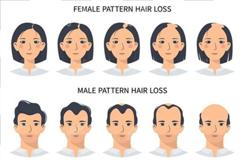 男女生發(fā)際線對(duì)比 男女生發(fā)際線對(duì)比