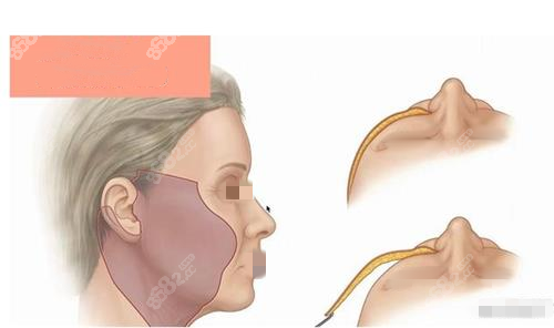 拉皮手術(shù)術(shù)中示意圖