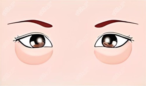眼袋的示意圖 眼袋的示意圖