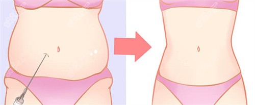 肚子吸脂前后對比 肚子吸脂前后對比