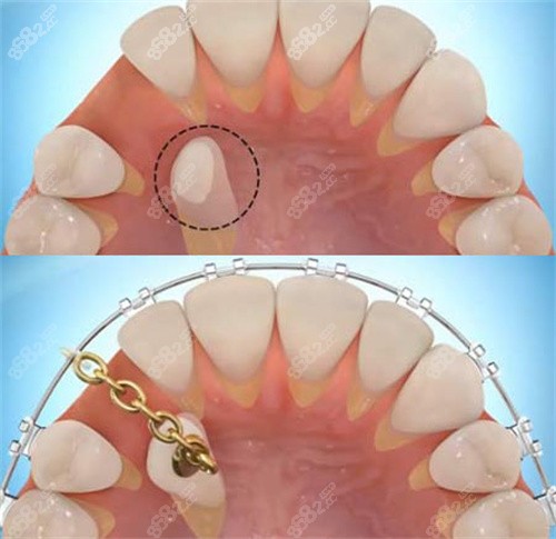 單顆牙齒牽引 單顆牙齒牽引