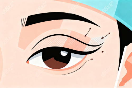 割雙眼皮卡通圖片展示 割雙眼皮卡通圖片展示