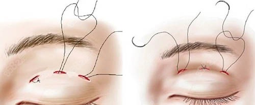 ?李光琴雙眼皮怎么樣？專注眼整形近20年，用技術(shù)和口碑給出了答案