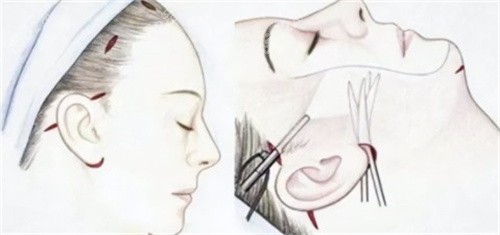 小切口拉皮手術(shù)