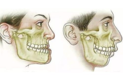 下頜角整形模型圖