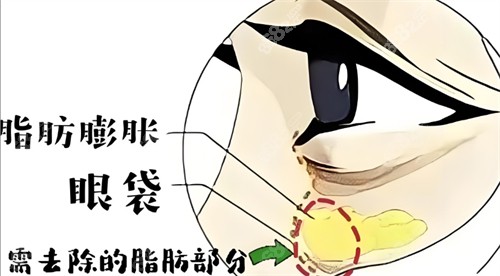 脂肪膨脹性眼袋需要去除的部分 脂肪膨脹性眼袋需要去除的部分
