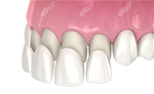 前牙四顆牙齒貼面