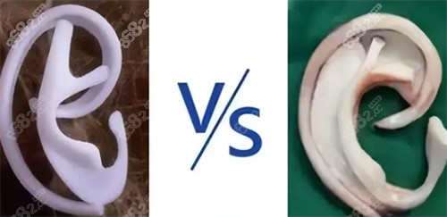 耳再造自體肋軟骨和生物材料對(duì)比 耳再造自體肋軟骨和生物材料對(duì)比
