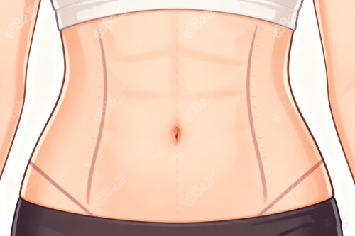 王擎腹壁成型手術(shù)貴嗎？ 2026廣州王擎醫(yī)師手術(shù)切口隱蔽度、修復(fù)期及價(jià)格