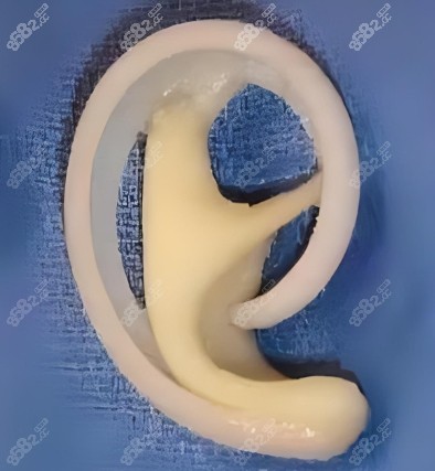 耳再造手術假體照片 耳再造手術假體照片