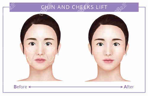 面部提升對比圖