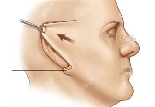 拉皮手術(shù)切口展示