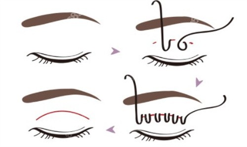 VLINE雙眼皮手術(shù) VLINE雙眼皮手術(shù)