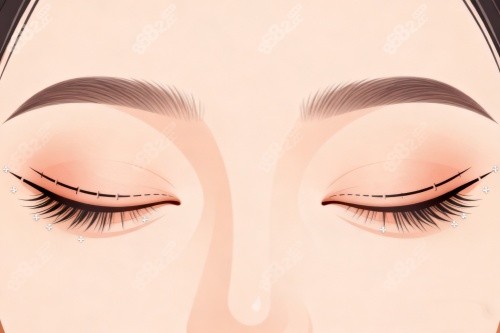 王衡健醫(yī)生做雙眼皮修復(fù)怎么樣？從網(wǎng)友真實(shí)經(jīng)歷看技術(shù)、審美與成效！