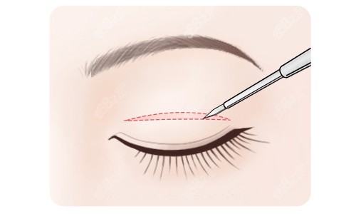 全切雙眼皮切口展示 全切雙眼皮切口展示