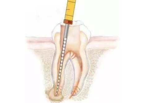 根管治療卡通展示圖