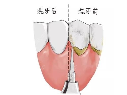 洗牙前后的區(qū)別