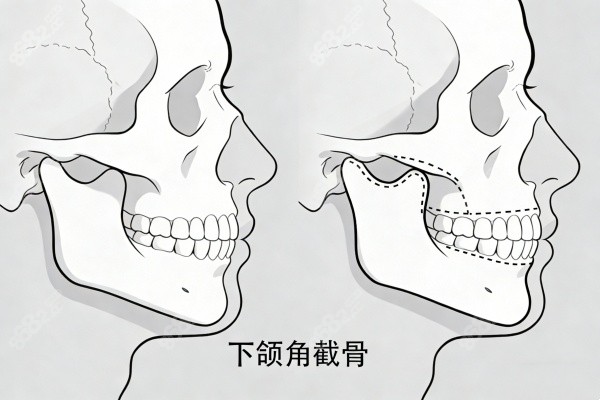 下頜角截骨卡通圖展示
