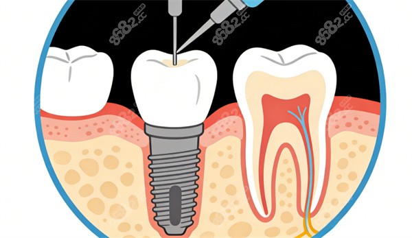 種植牙齒卡通圖