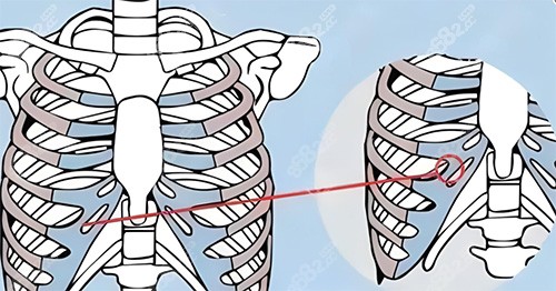 隆鼻肋骨鼻所用肋骨圖