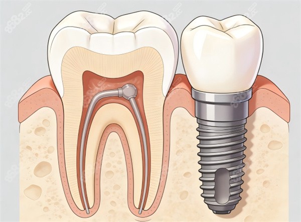 種植牙插畫圖片展示