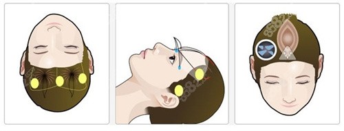 額頭提升術(shù)