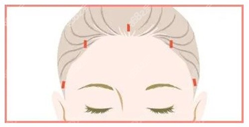額頭提升術(shù)切口
